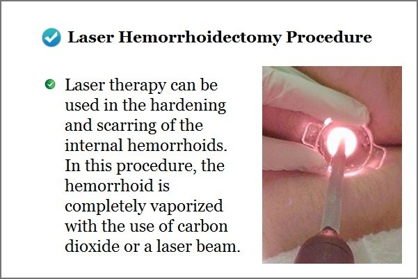 Laser Surgery for Hemorrhoids Treatment
