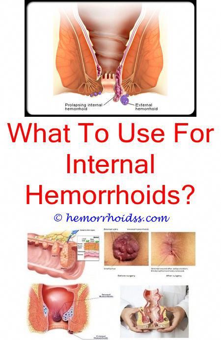 Marvelous Cool Ideas: Can Hemorrhoid Stop Someone From ...