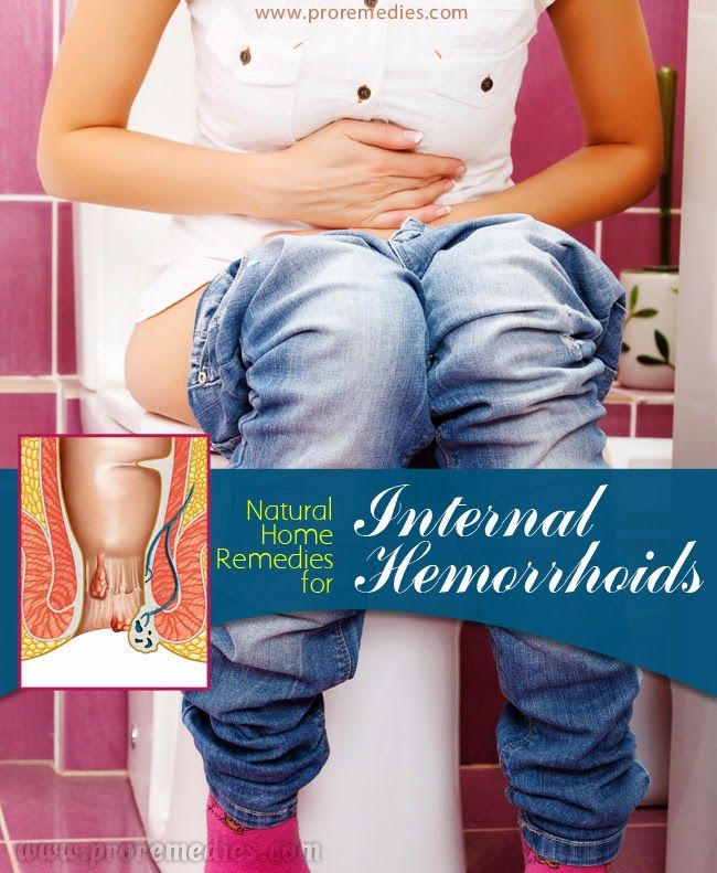 Natural Home Remedies for Internal Hemorrhoids