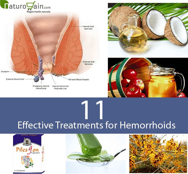 Natural Treatment for Hemorrhoids