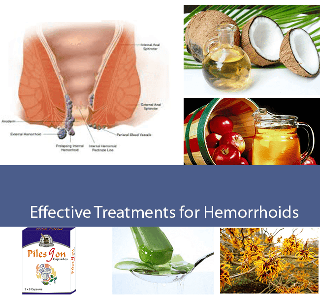 Natural Ways To Cure Hemorrhoids