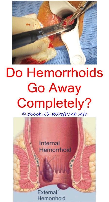 Not many people know exactly how to successfully alleviate hemorrhoids ...