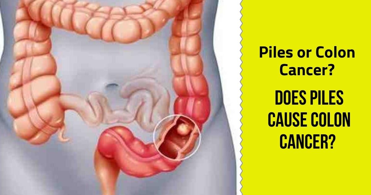 Piles or Colon Cancer? Does Piles cause Colon Cancer