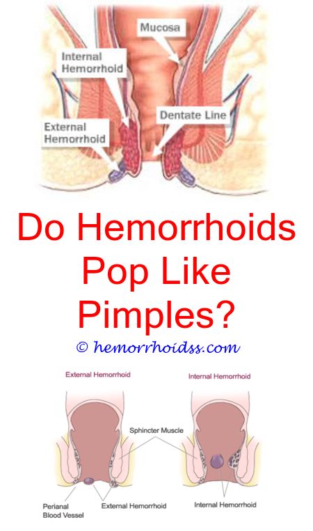 Pin en How To Treat Hemorrhoids