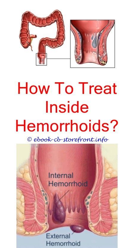 Pin en treating hemorrhoids