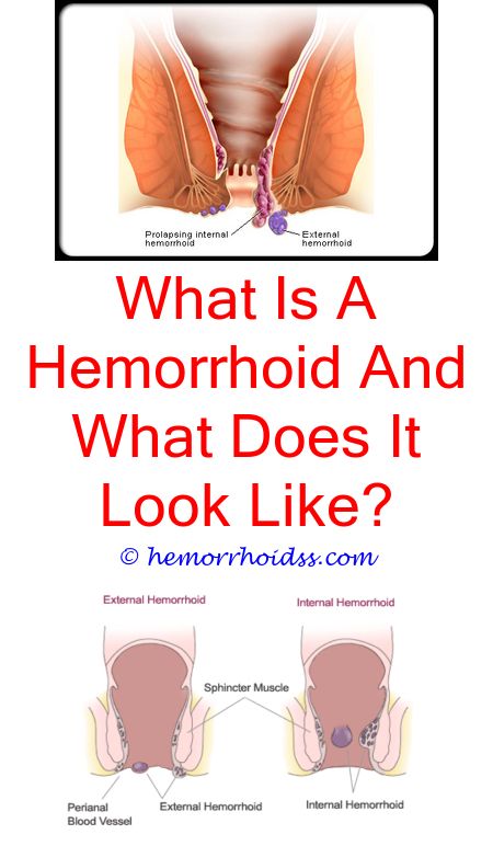 Pin on Bleeding Hemorrhoids Treatment