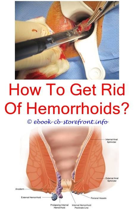 Pin on Can Hemorrhoids Bleed Out