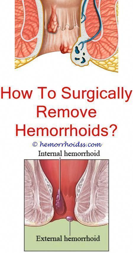 Pin on Hemorrhoids During Pregnancy