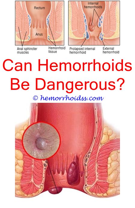 Pin on Hemorrhoids Pictures