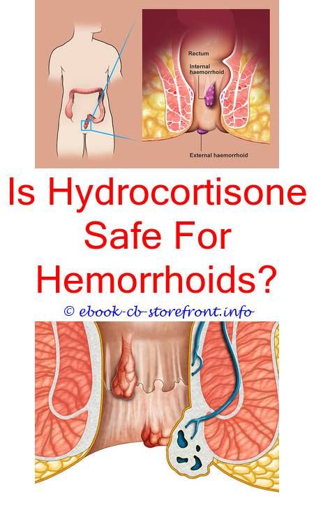Pin on How Are Hemorrhoids Treated At Home