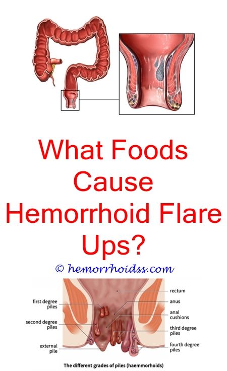 Pin on How To Heal Hemorrhoids
