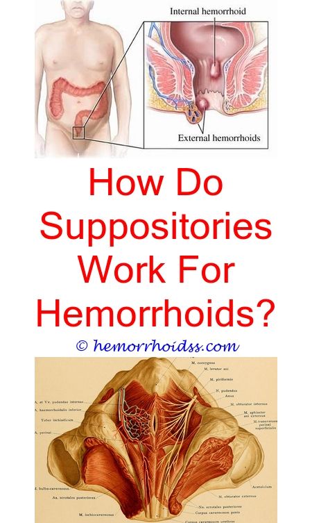 Pin on How To Tell If You Have Hemorrhoids