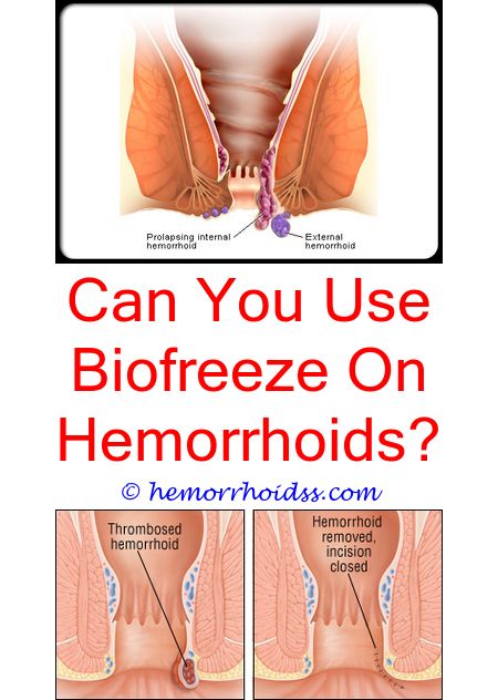 Pin on Internal Hemorrhoids