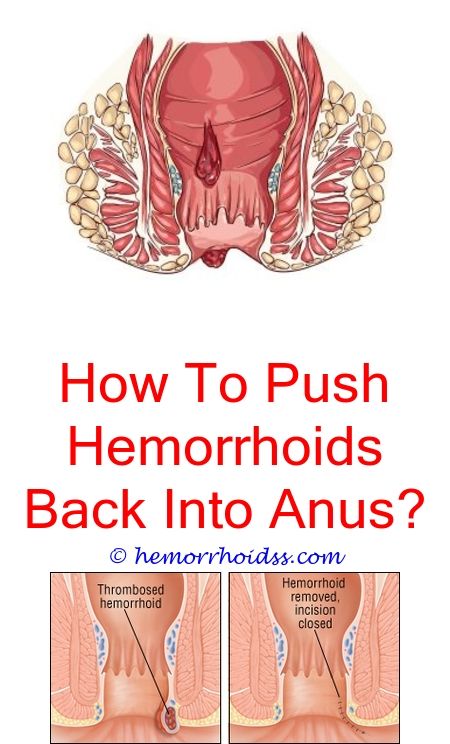 Pin on Itchy Hemorrhoids