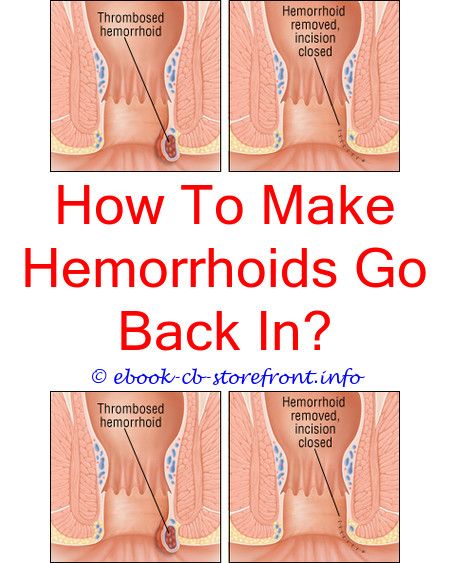 Pin on Treating Hemorrhoid