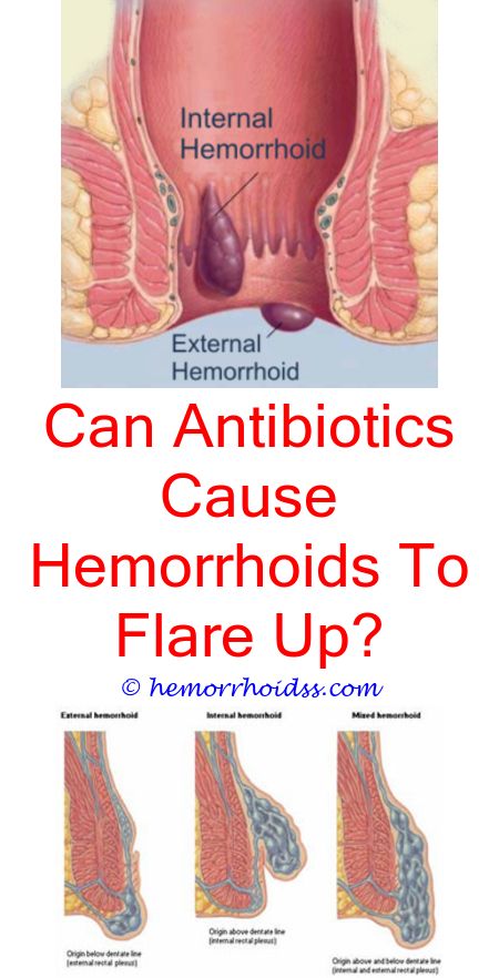 Pin on What Do Hemorrhoids Look Like