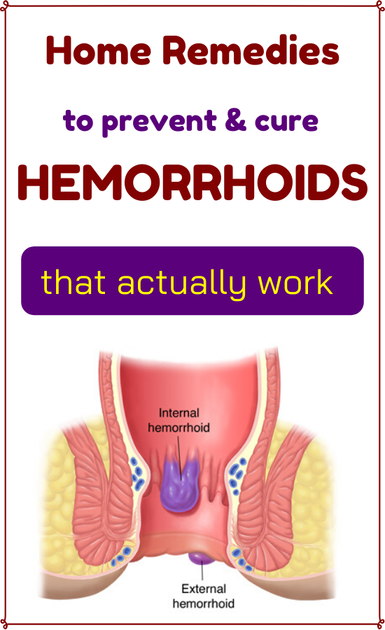 Prevent hemorrhoids with these home remedies in 2020