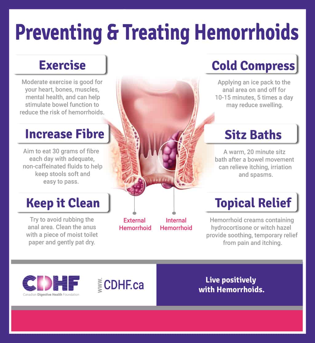 Preventing &  Treating Hemorrhoids Infographic