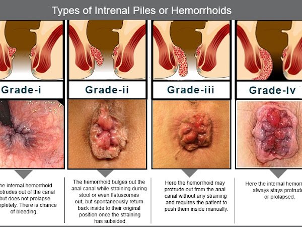 Real Female Hemorrhoids / Pin On Icd 10 Code For ...