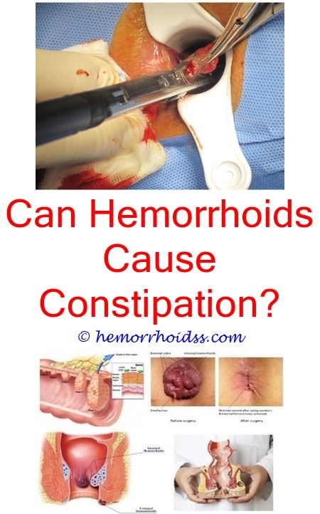 Should You See A Doctor For External Hemorrhoids? can diaper rash cream ...