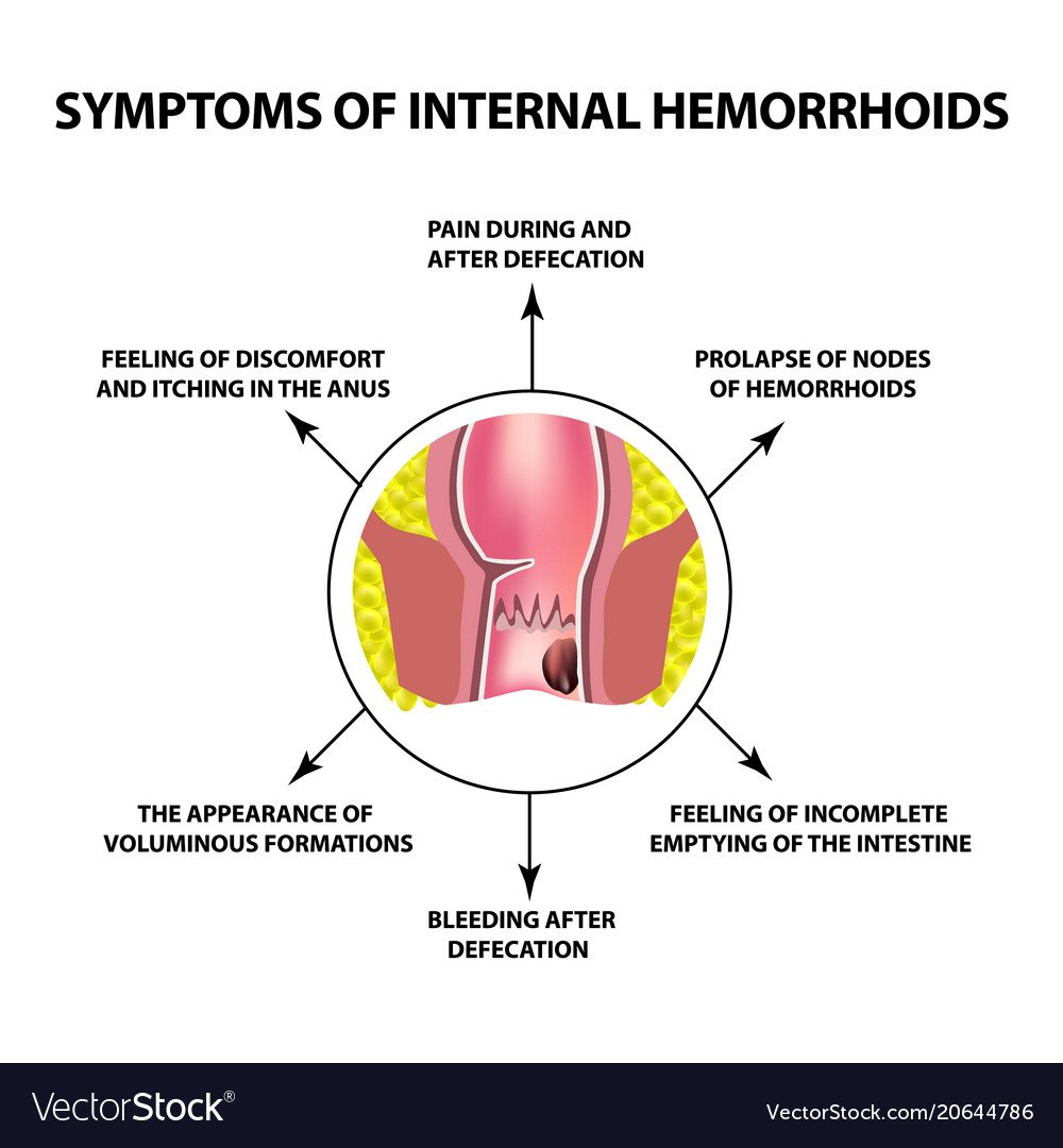 Symptoms internal hemorrhoids hemorrhoidal node Vector Image