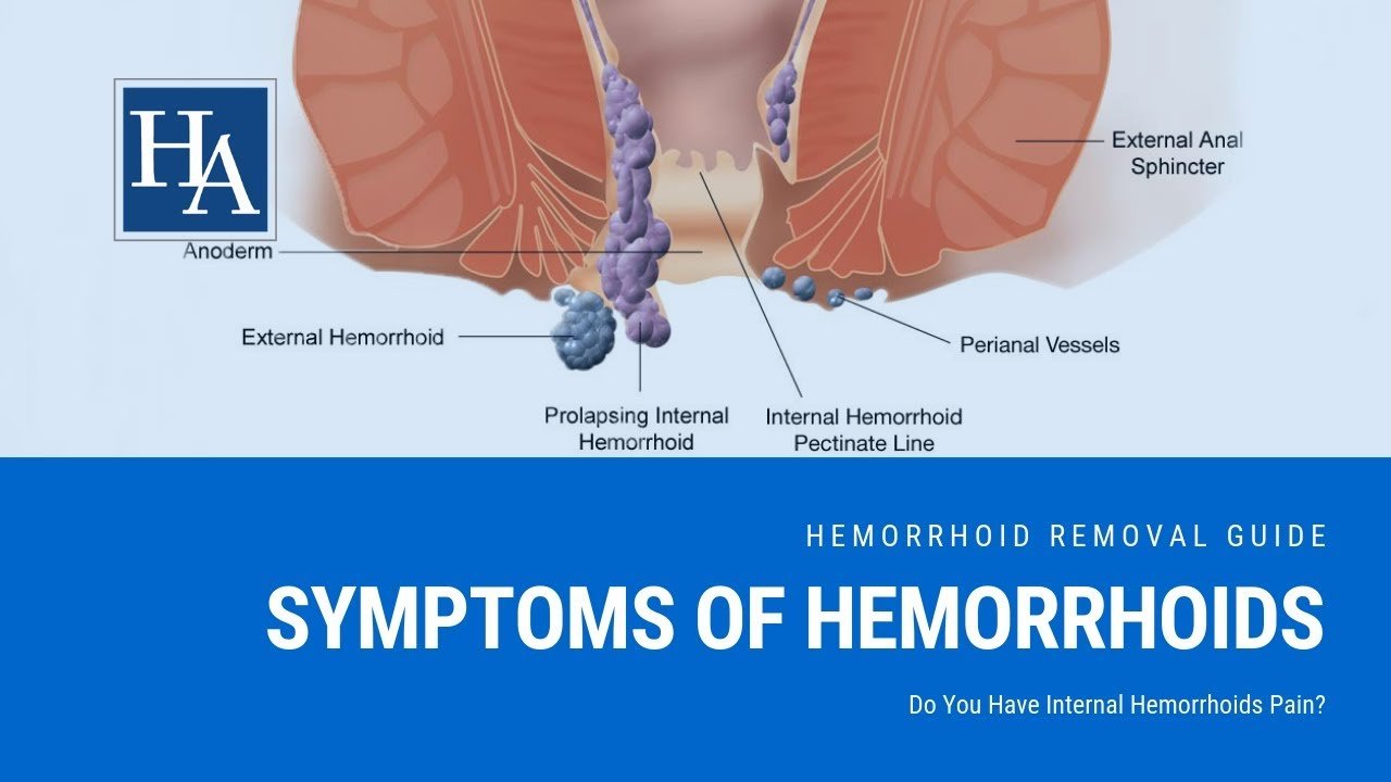 Symptoms of Internal Hemorrhoids