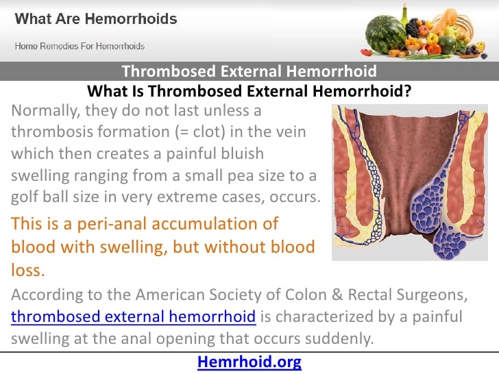 Symptoms Of Internal Thrombosed Hemorrhoids