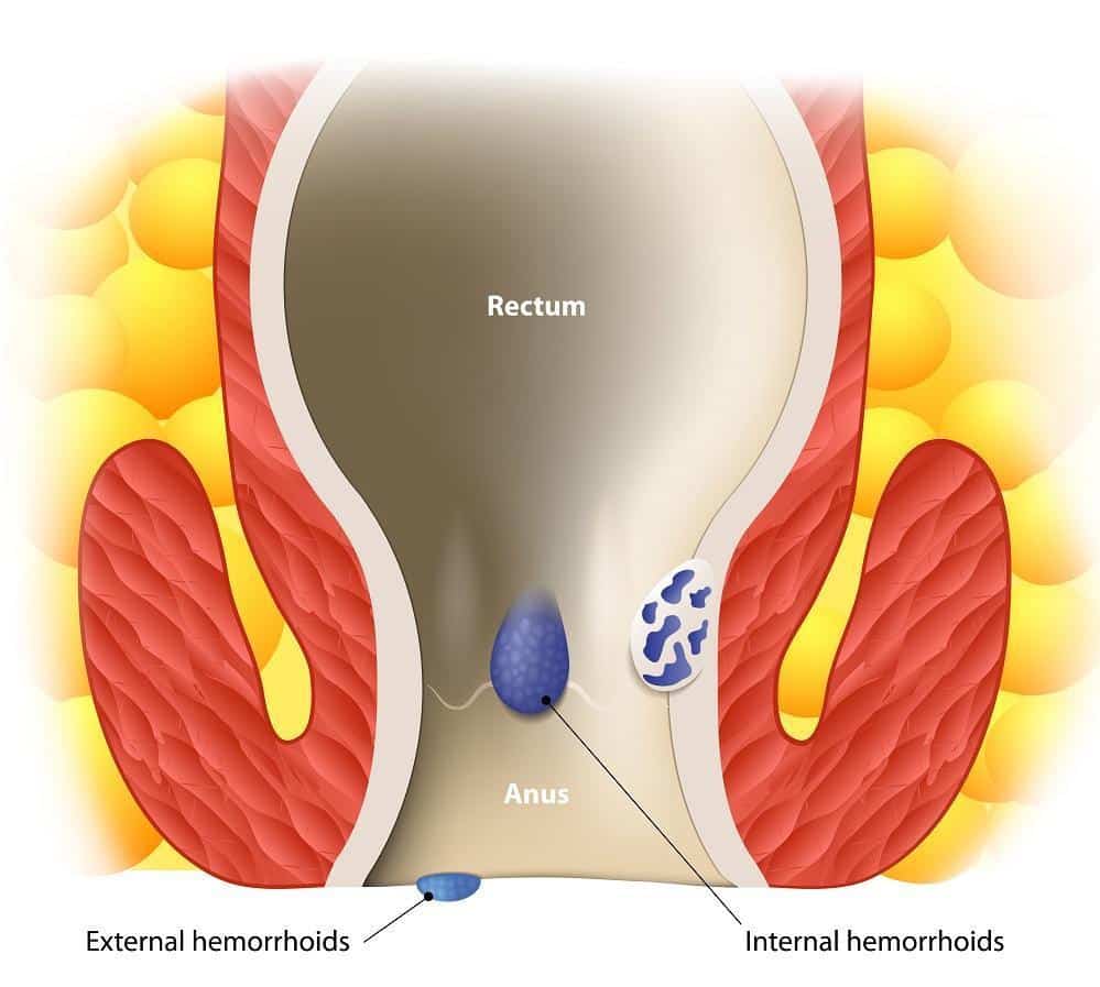 The Benefits of Natural Remedies for Hemorrhoids
