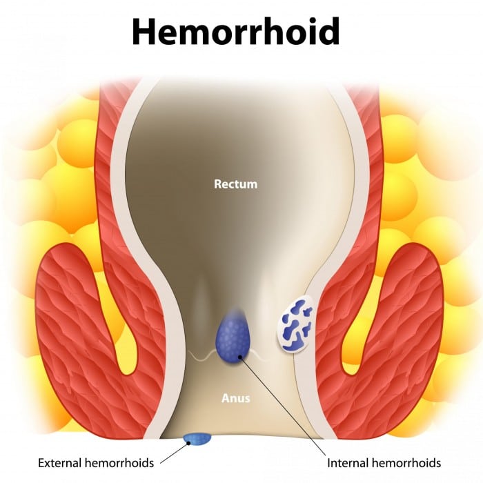 The Connection Between Hemorrhoids and Pruritus Ani
