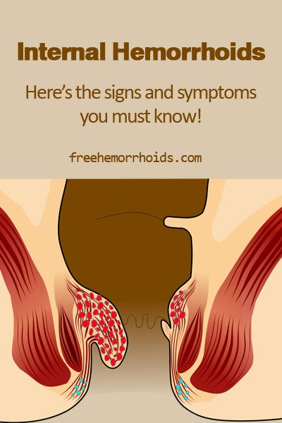 These Internal Hemorrhoids Signs, Symptoms and Treatments ...