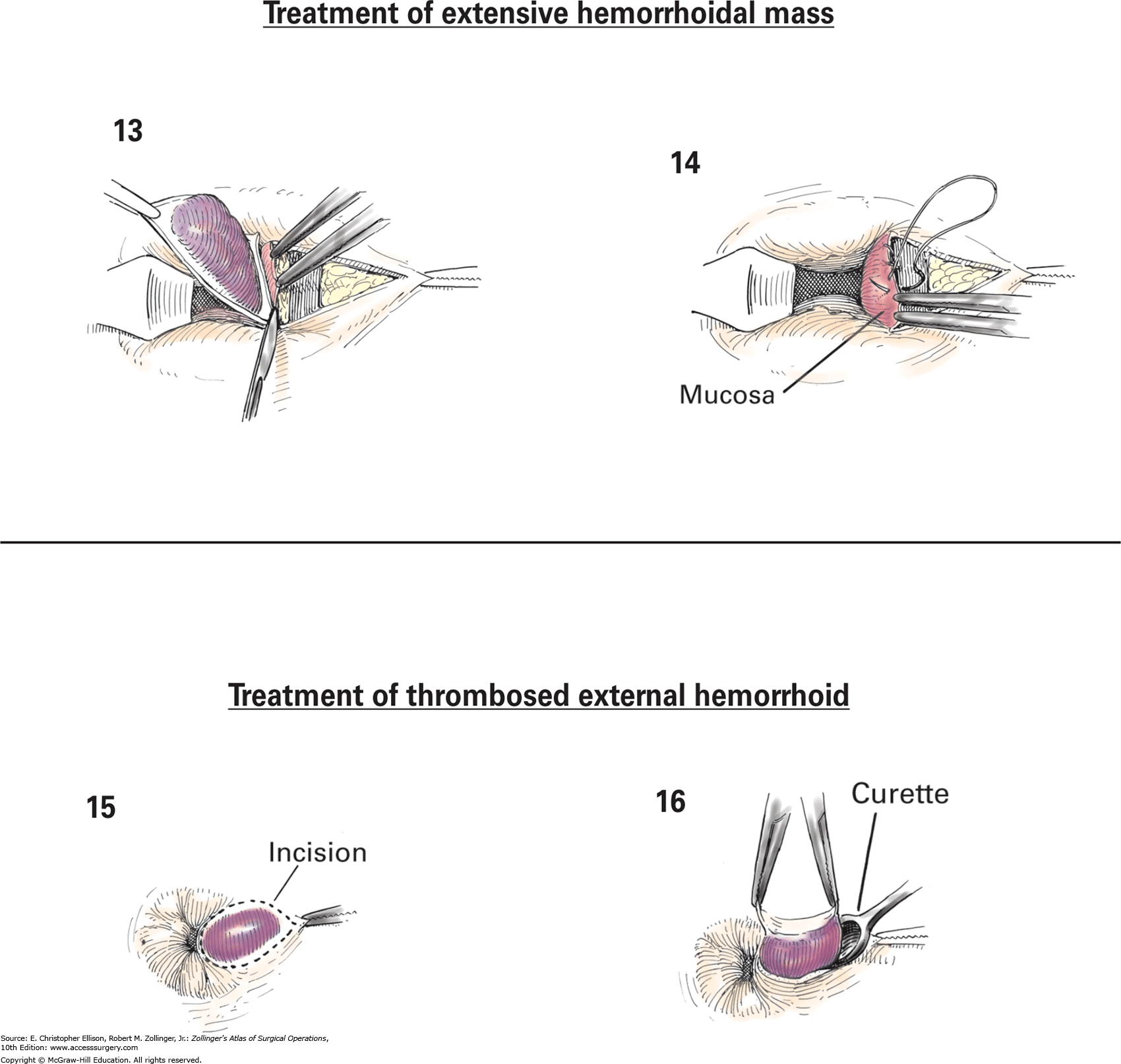 Thrombosed Hemorrhoid Hard Lump