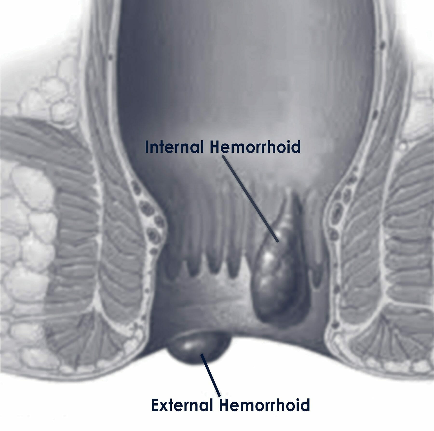 Thrombotic Hemorrhoids