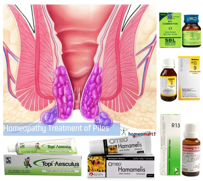 Top Homeopathy medicine in drops ointment for Piles, Hemorrhoids