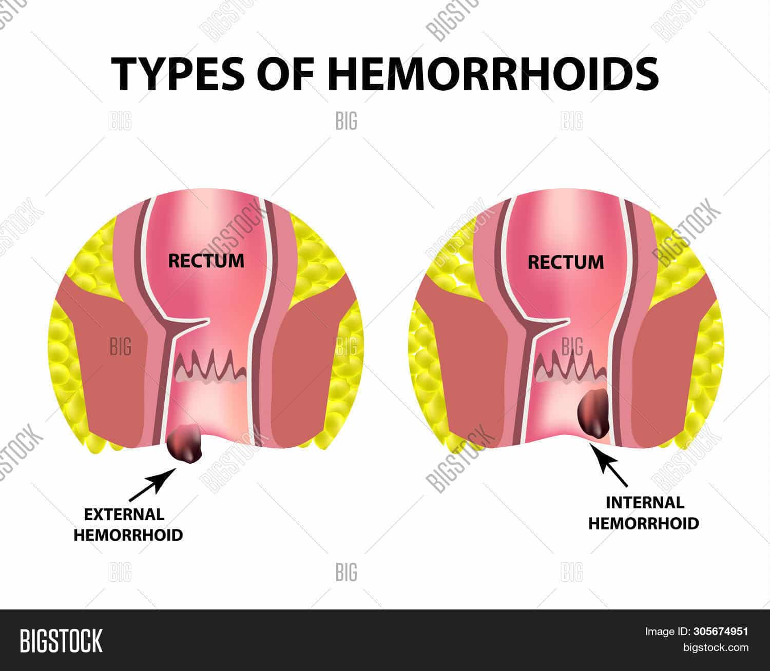 Two Types Hemorrhoids Image &  Photo (Free Trial)