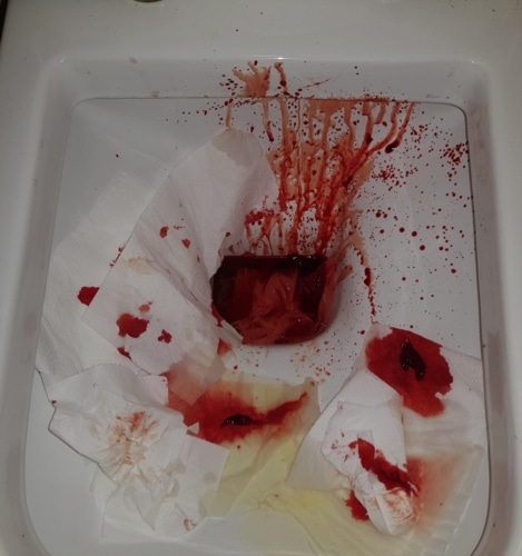 (WARNING GRAPHIC PHOTO) Is this normal bleeding for haemorrhoids ...