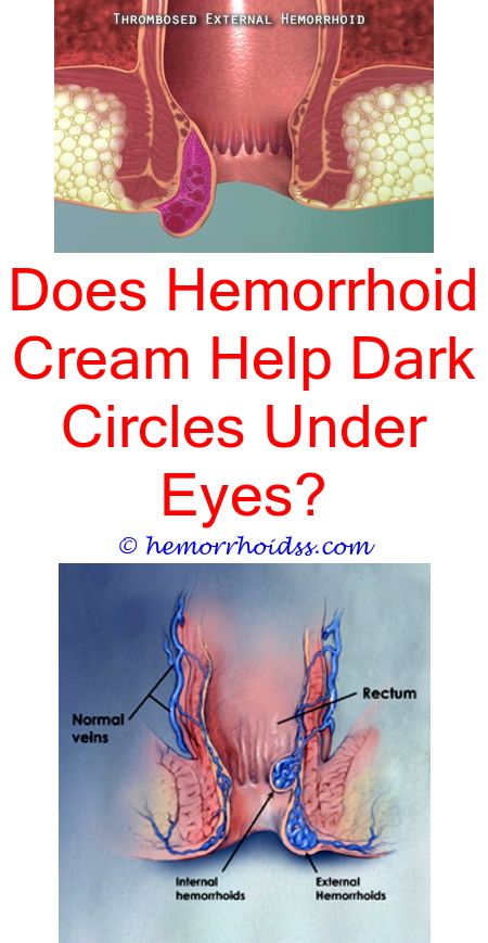 What Aggravates Hemorrhoids?