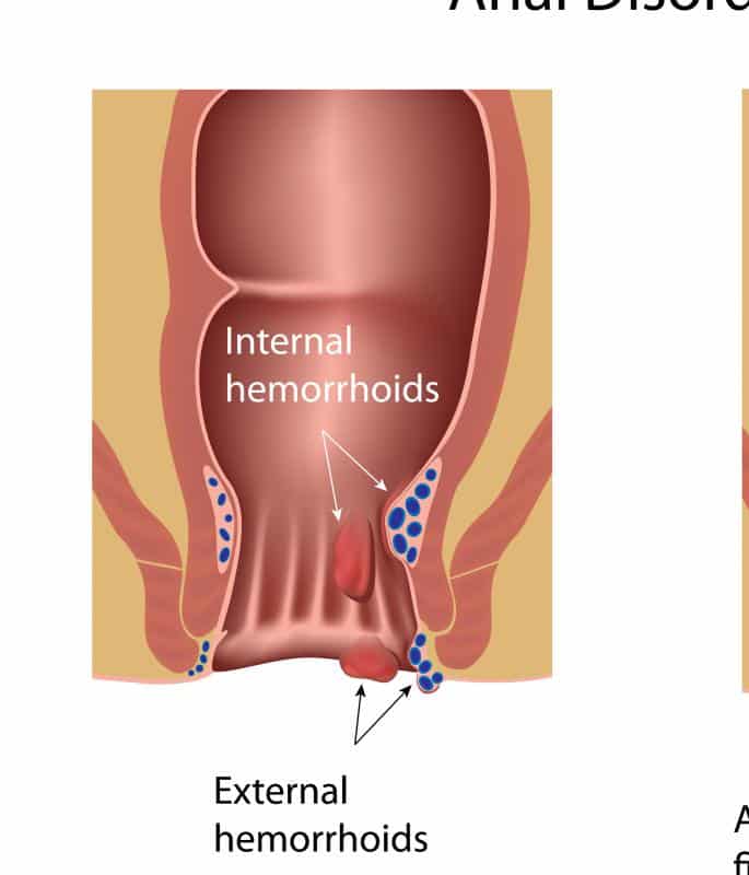 What are Chronic Hemorrhoids? (with pictures)