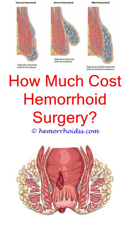 What Are Hemorrhoids?