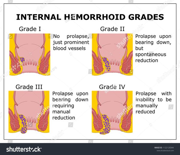 What are the causes of a grade 4 hemorrhoid?