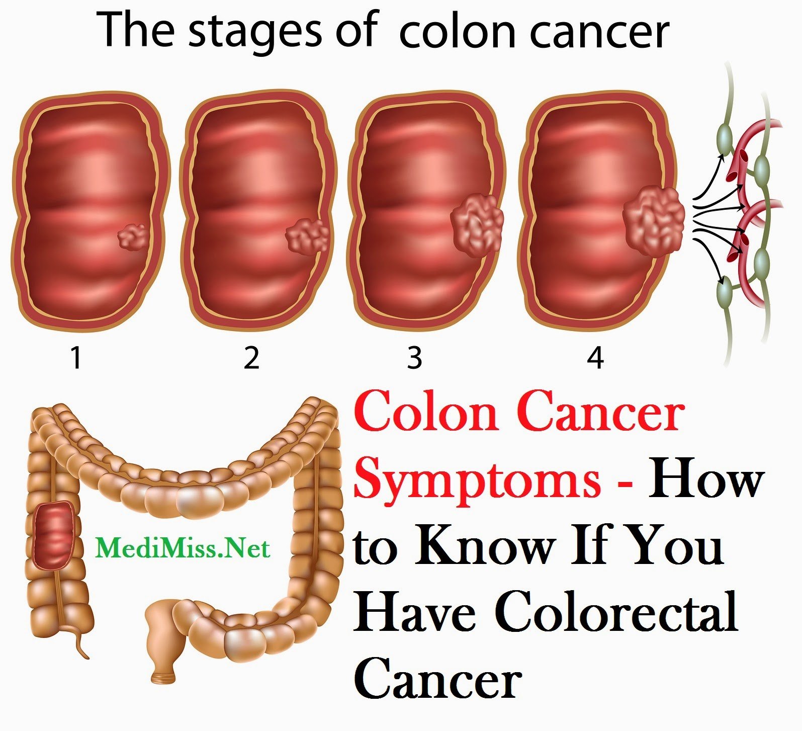 What Are The Symptoms Colon Cancer