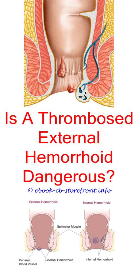 What Can Help Hemorrhoids During Pregnancy