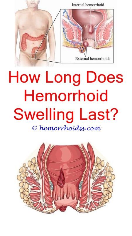 What Can You Do To Help Hemorrhoids? can internal ...