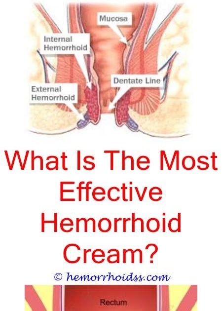 What Can You Do To Help Hemorrhoids? what causes chronic ...