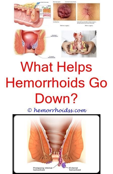 What do doctors do to get rid of hemorrhoids?.Are ...
