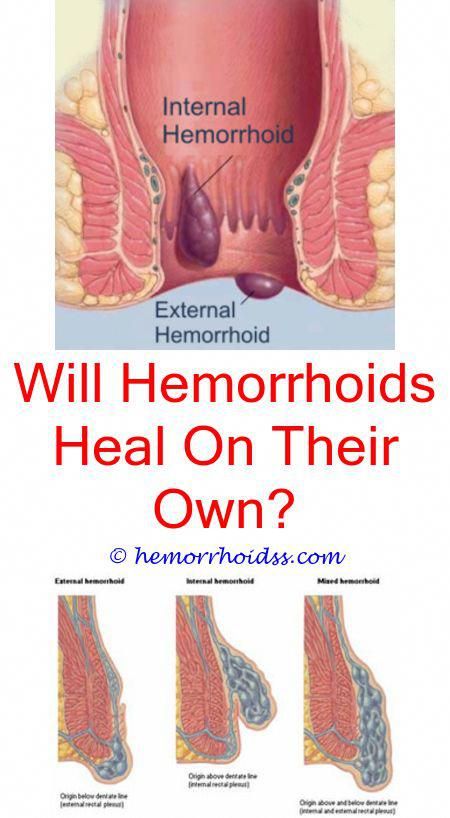 What Do Hemorrhoids Look Like After Giving Birth