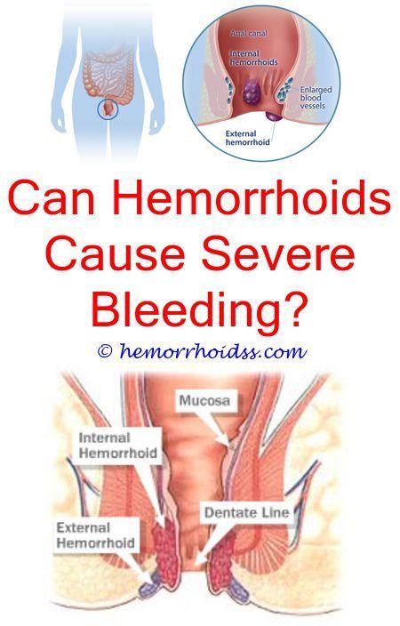 What Do Yoh Do For Hemorrhoids? can hemorrhoids cause a ...