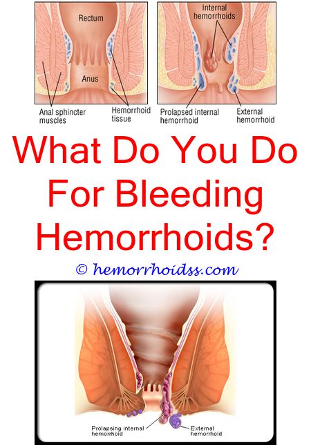 What Doctor Should I Go To For Hemorrhoids