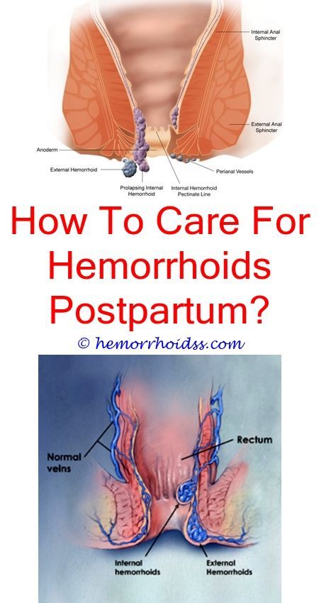 What does a thrombosed external hemorrhoid look like?.Is sitting or ...