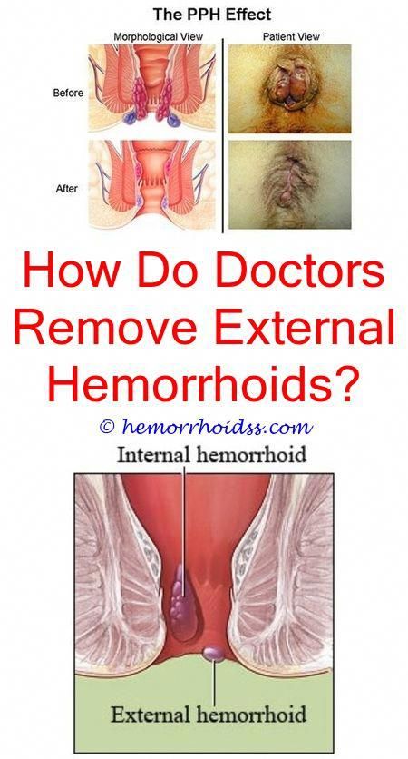 What Does Bleeding Hemorrhoids Look Like? how long does a ...