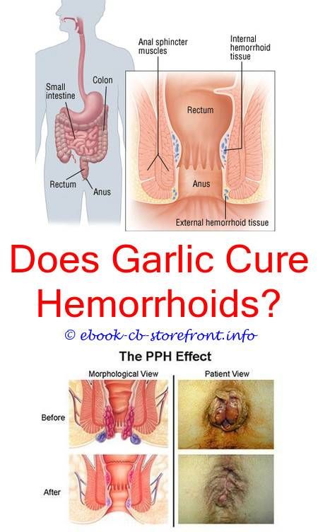 What Does Preparation H Do For Hemorrhoids